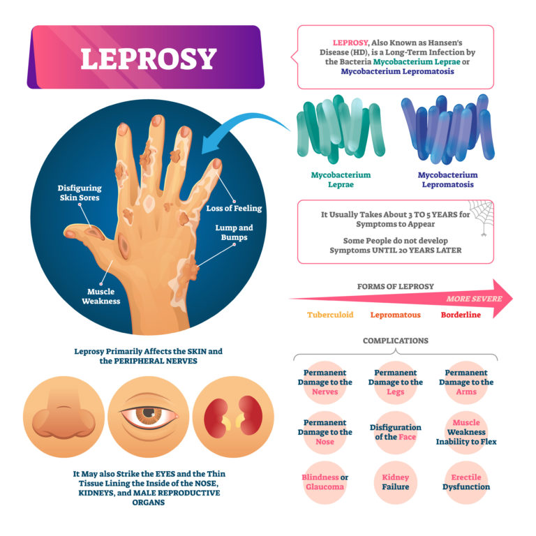 giant microbes leprosy