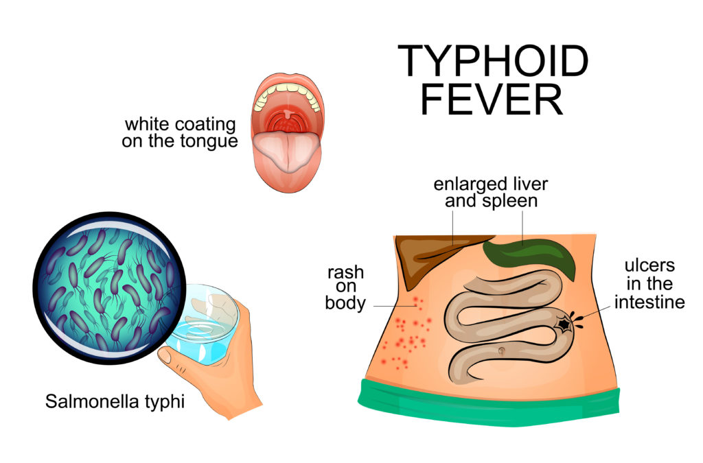 Examining Salmonella Typhi and Typhoid Fever - GIDEON - Global ...